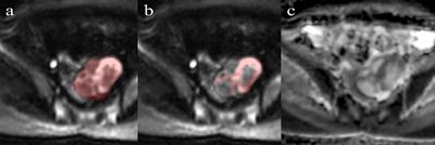 Diffusion-weighted imaging-based radiomics in epithelial ovarian tumors: Assessment of histologic subtype